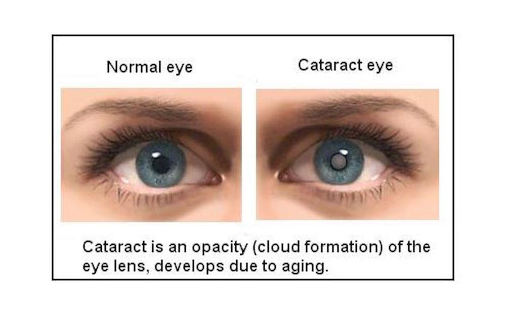 Cataract Surgery & IOL Implant