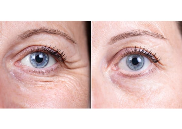 Botox / Fillers
