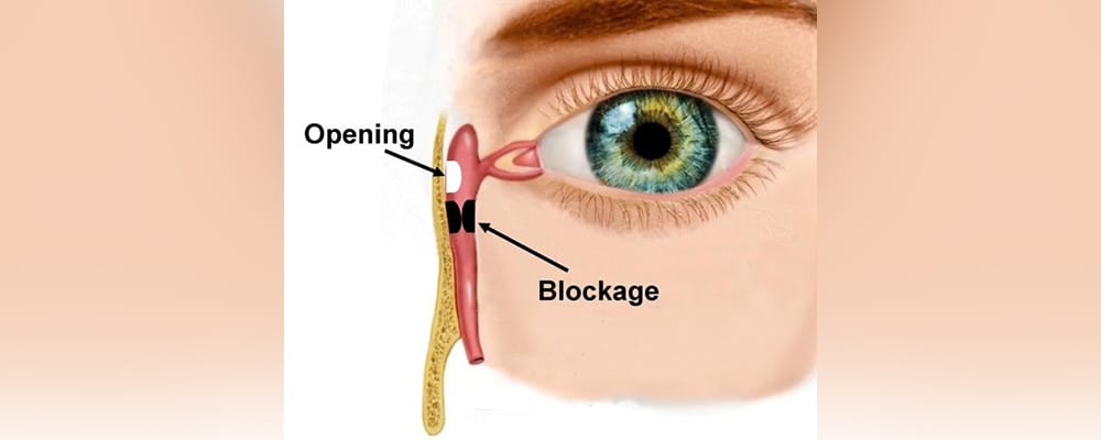 DCR Surgery