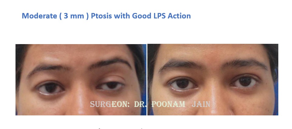 PTOSIS