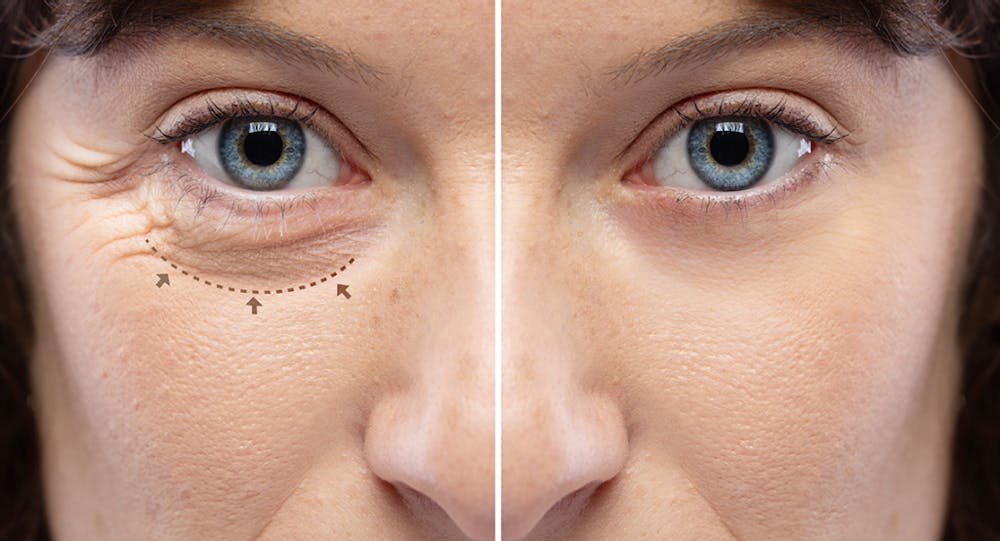 Blepharoplasty