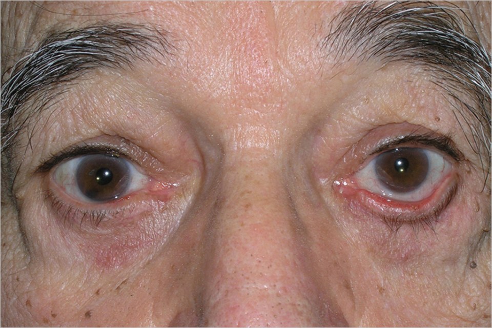 Ectropion