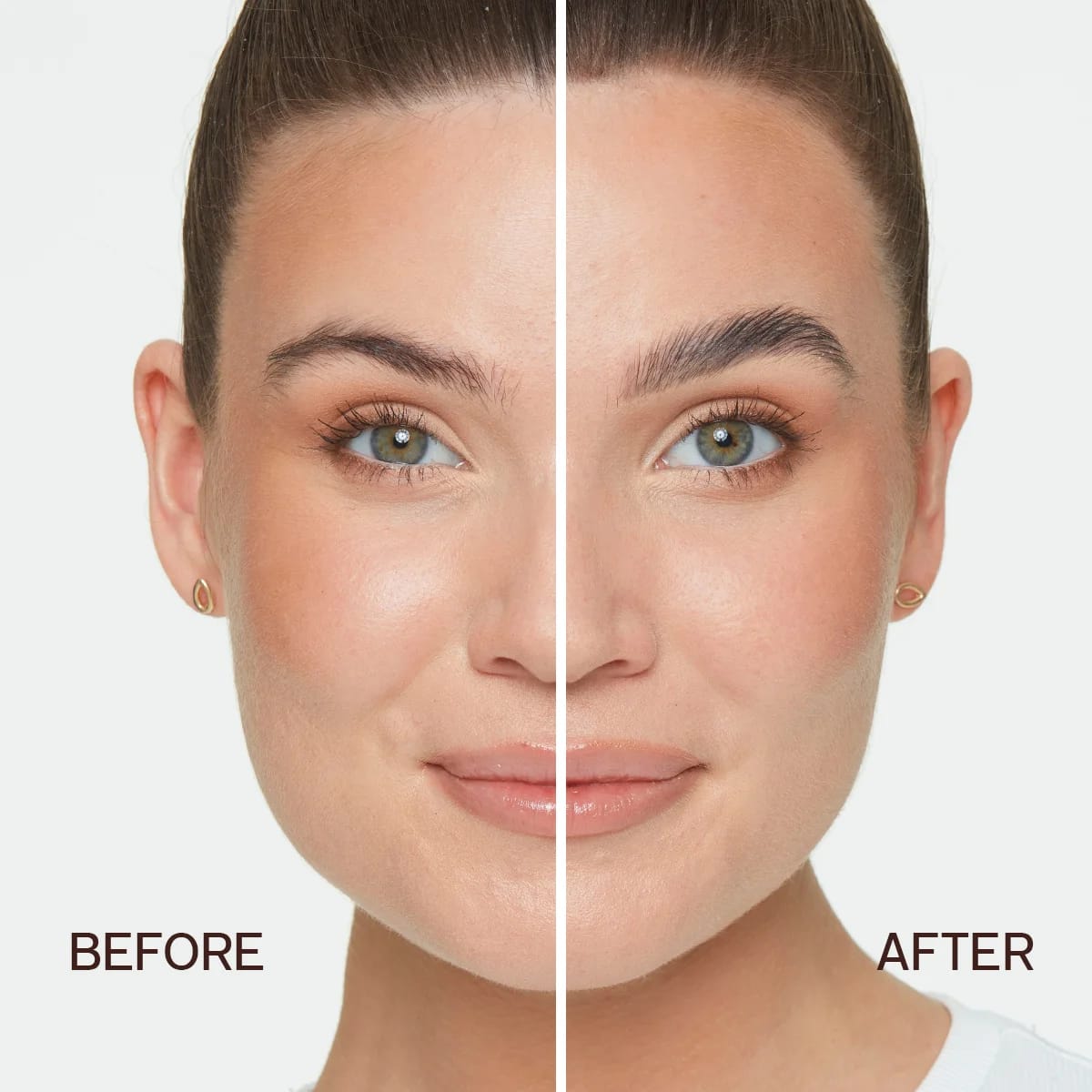 Brow Lift