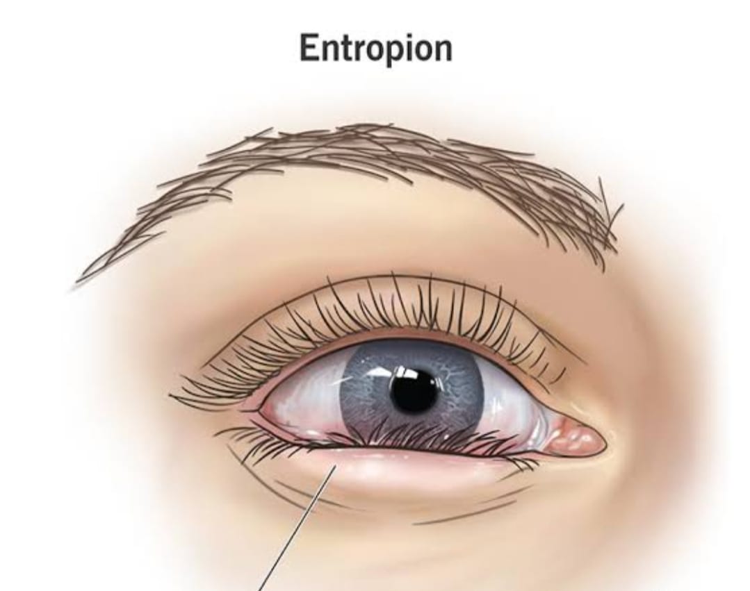 Entropion