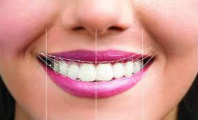 Smile designing