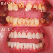 Full mouth rehabilitation