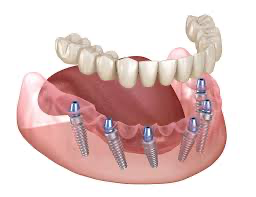 Fixed dentures/Full mouth implants