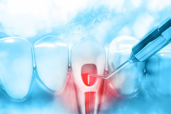 Laser RCT (Root Canal Treatment)
