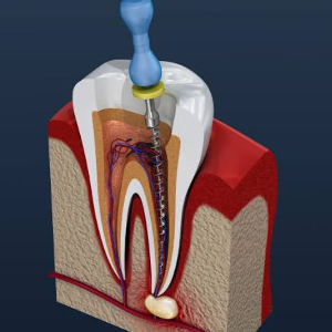 Root Canal treatment