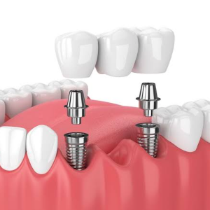 Dental implants