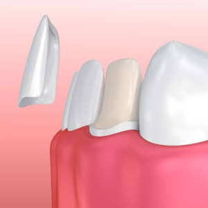 Dental Veneers