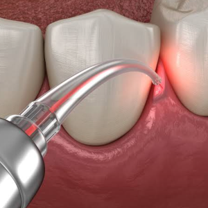 Laser Dentistry