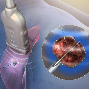 Interventional Oncology