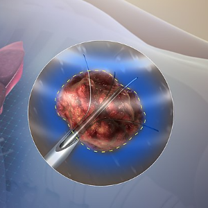 Preventive Oncology and Screening Services