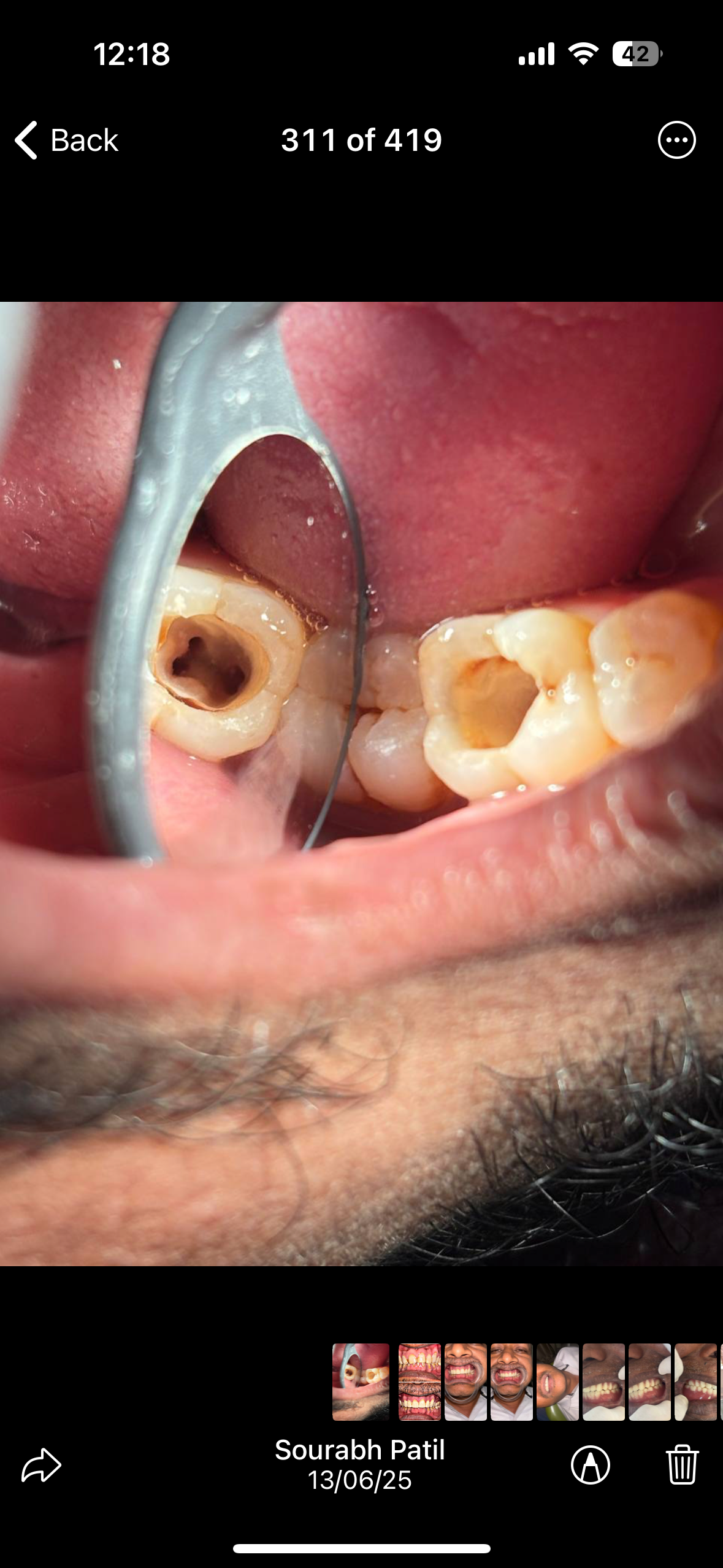 Root canal treatment