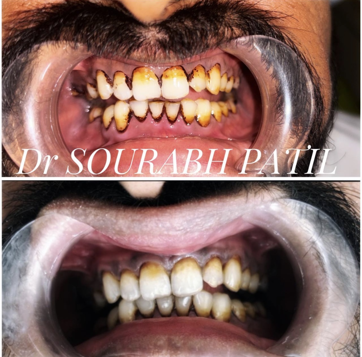 Tooth scaling and polishing