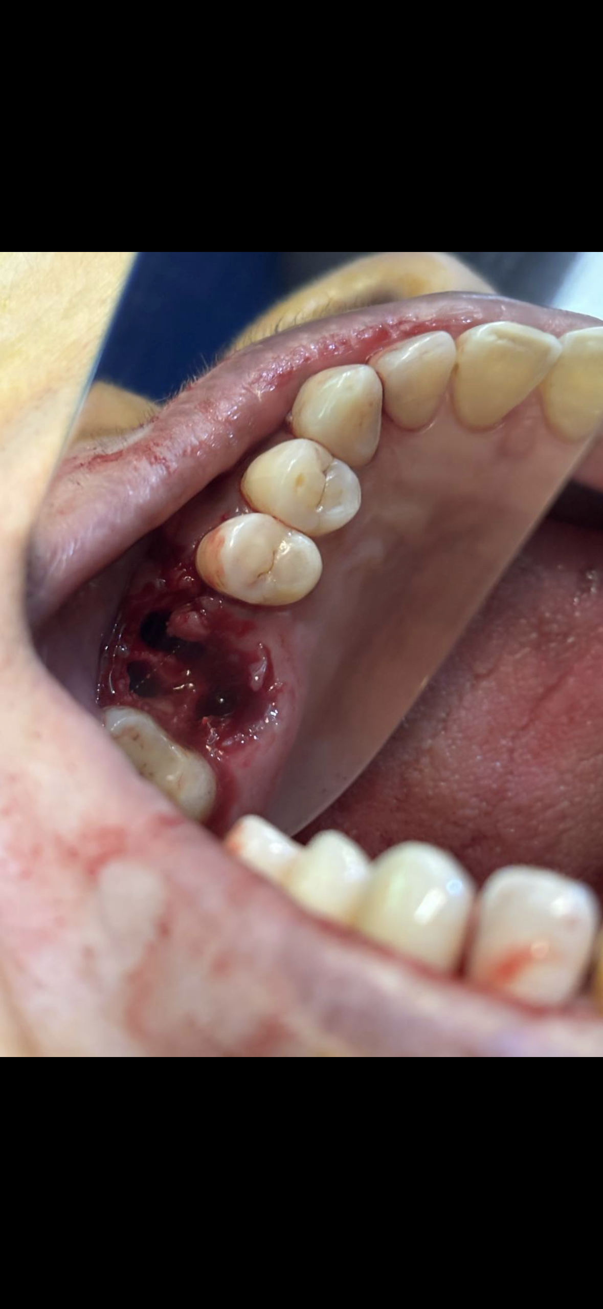 Tooth extraction surgery