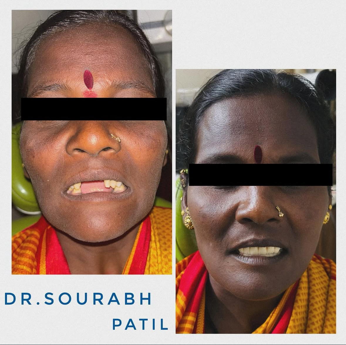 Fixed partial dentures