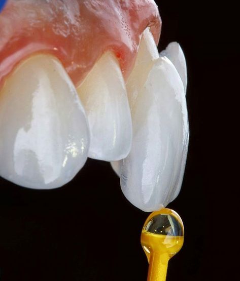 VENEERS