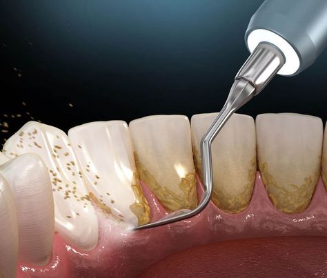 TEETH CLEANING