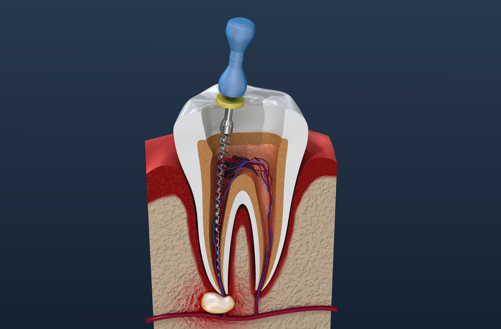 Root canal