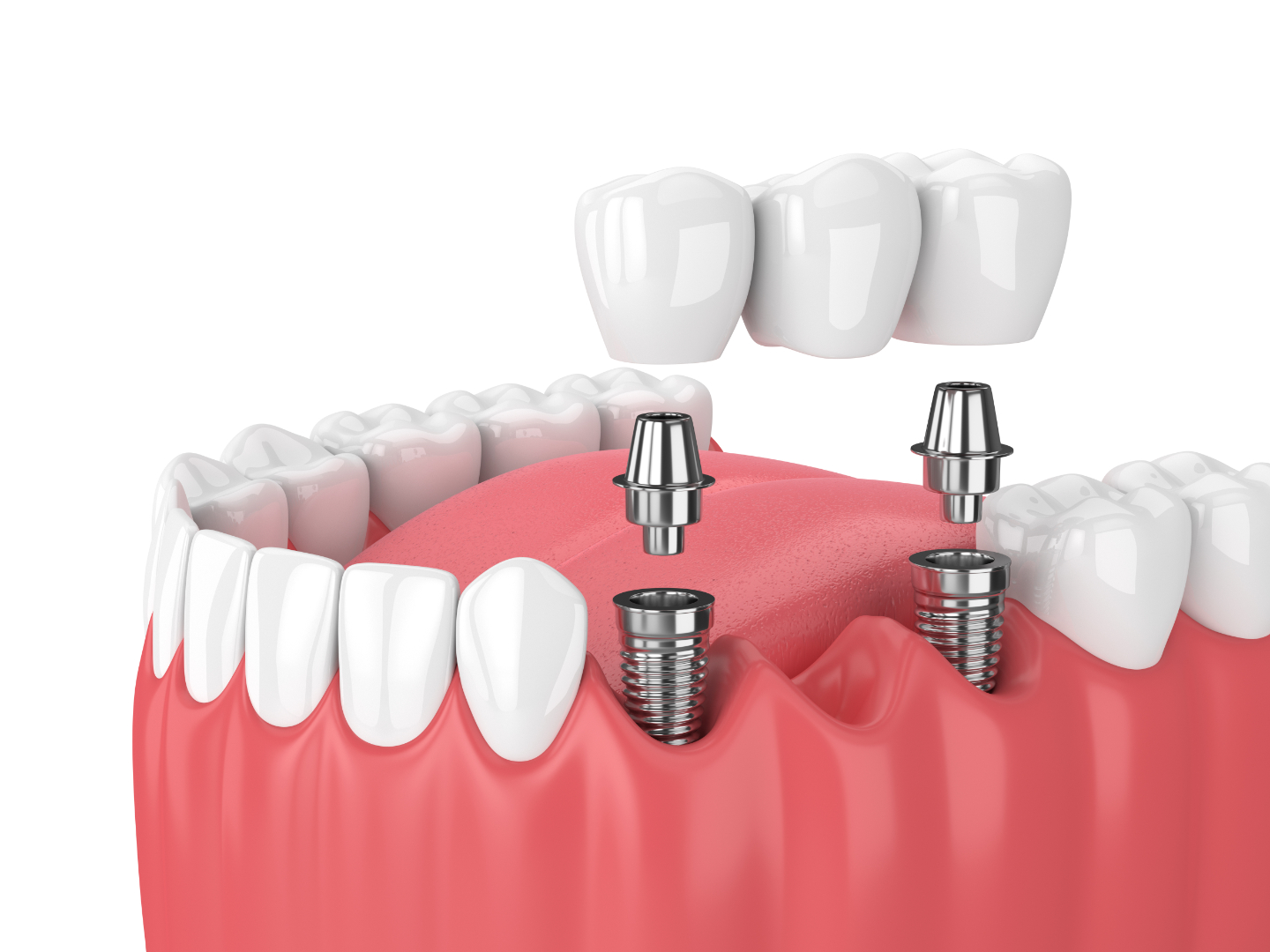 Implant Dentistry