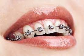 Orthodontics dentistry