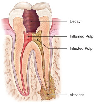 ROOT CANAL TREATMENT & FILLINGS