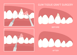 GUM SURGERY