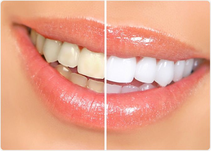 Teeth Cleaning