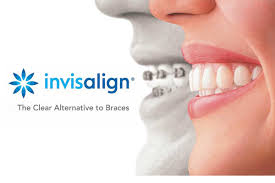 Aligners