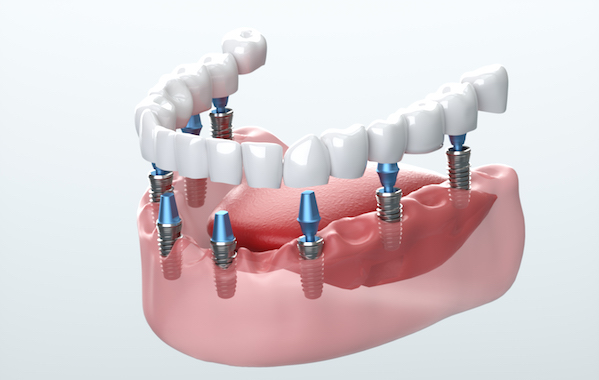Implant Dentistry