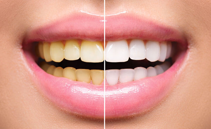 Dental bleaching