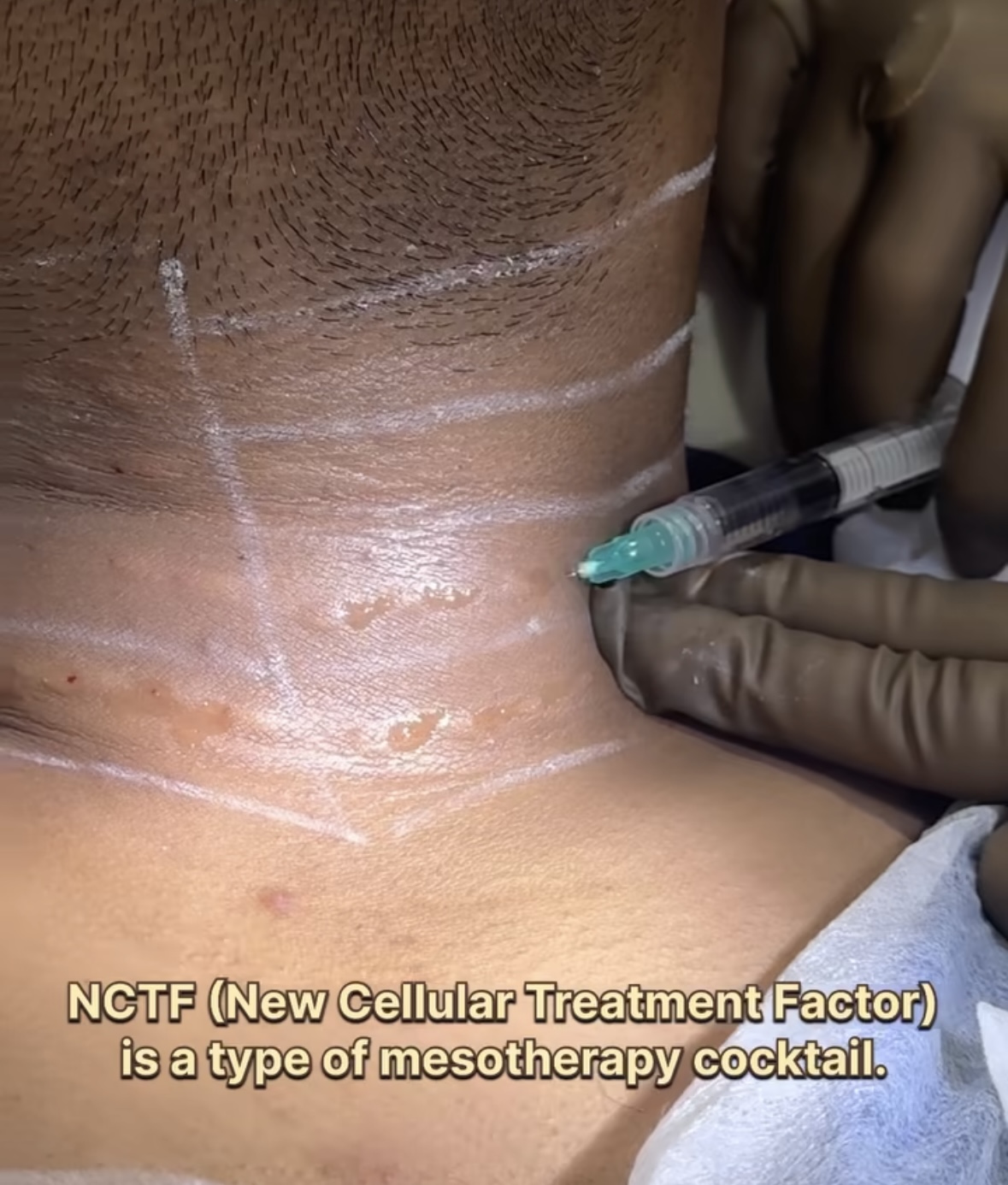 NcTF treatment