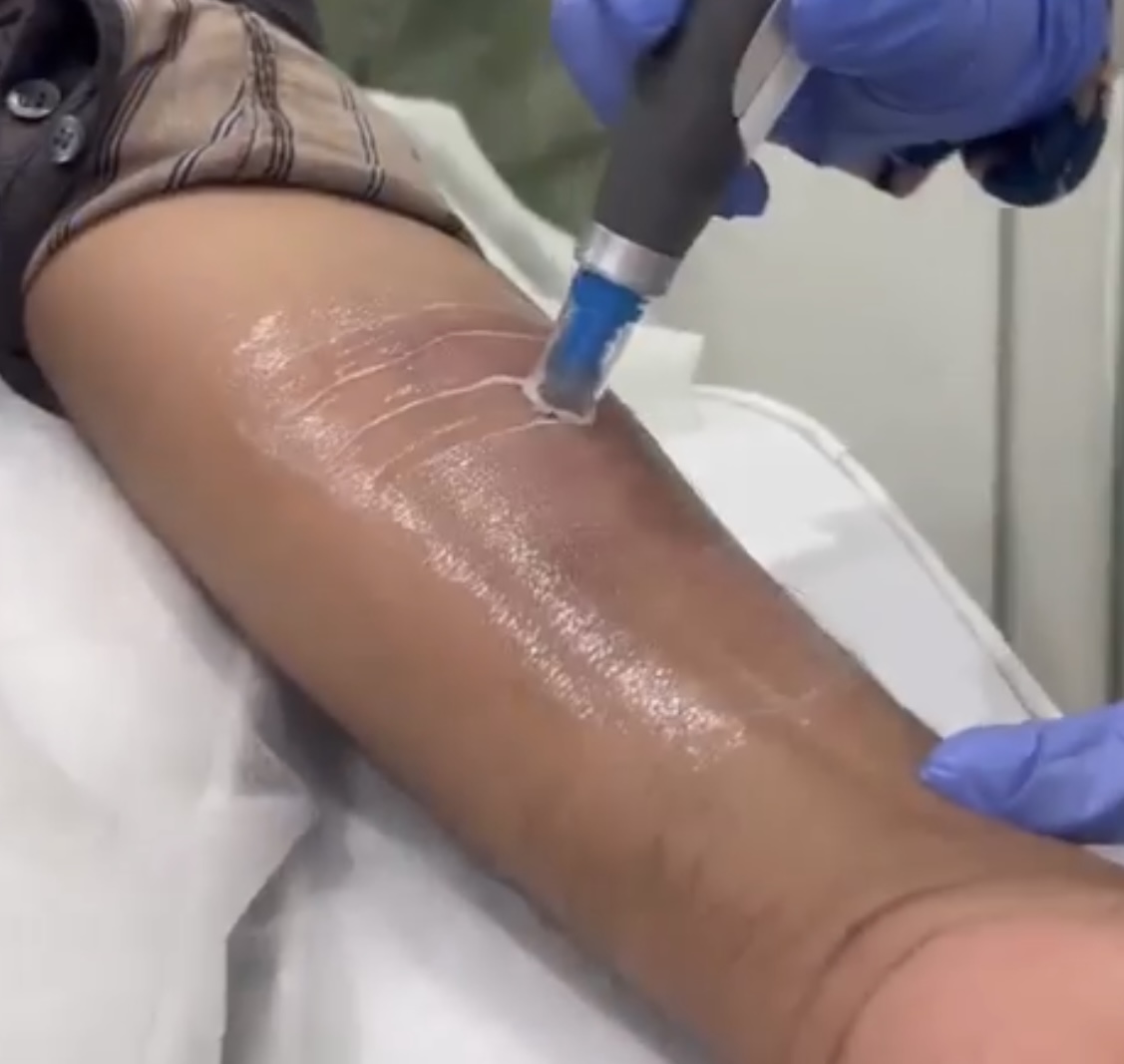 Microneedling treatment