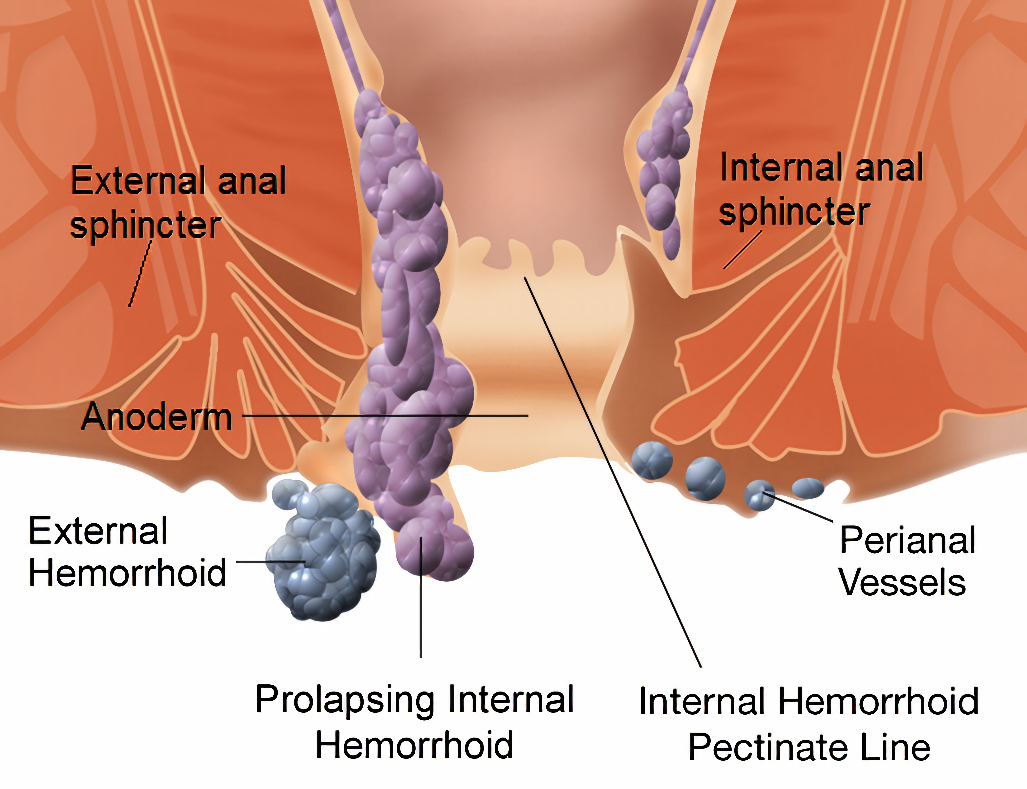Piles/ Haemorrhoids