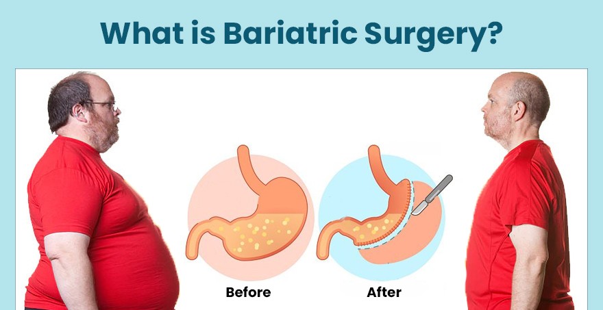 Bariatric Surgery