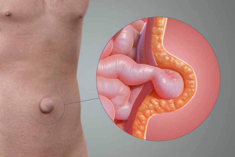 Umbilical Hernia