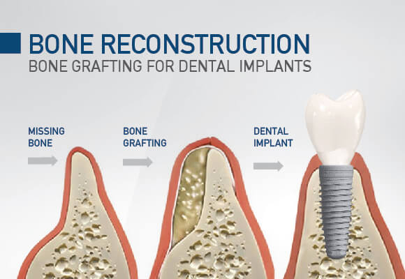🦴 Dental Implants & Bone Reconstruction