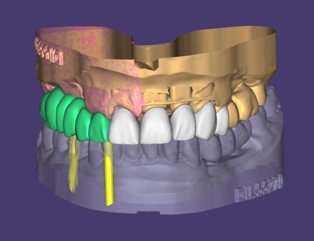 Digital planning & Scanning