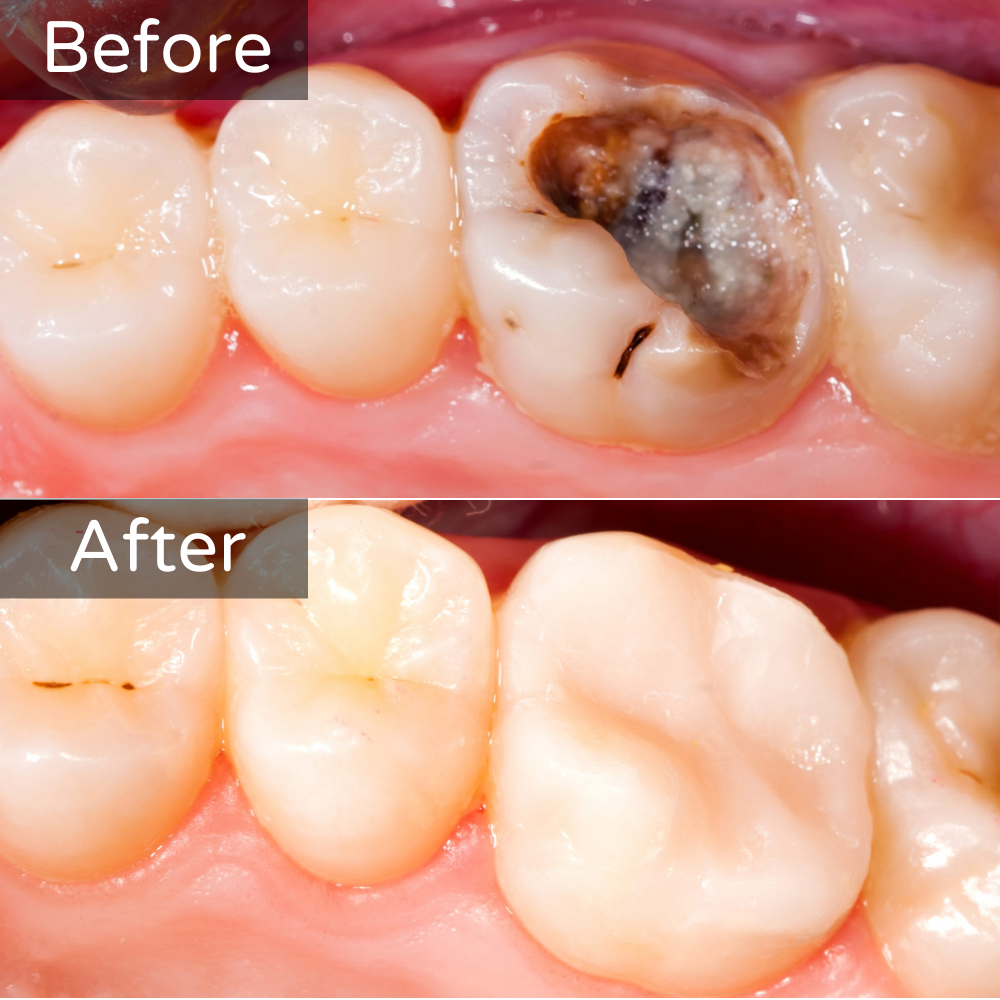 Composite/Tooth coloured fillings