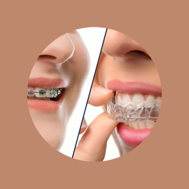 Braces/Invisalign