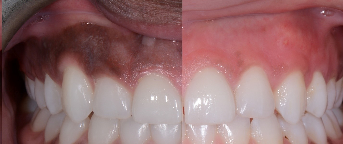 Gum depigmentation