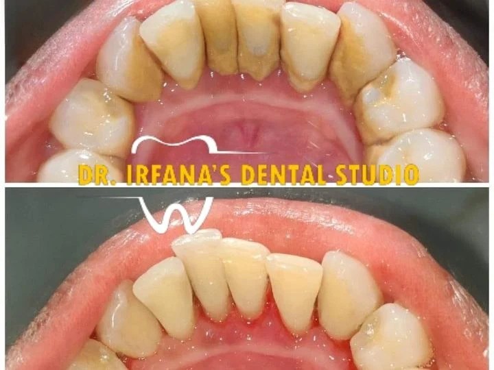 Teeth cleaning and polishing