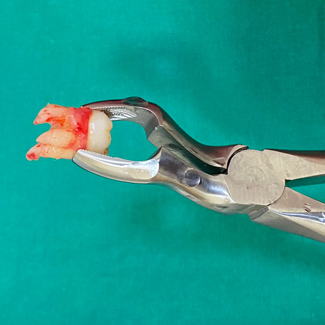 Extractions and Wisdom tooth removal