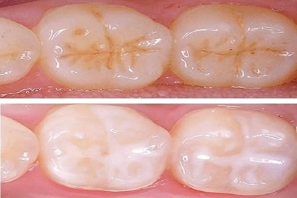 Pit and Fissure Sealants