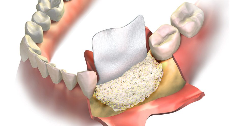 Bone grafting and sinus lift procedures