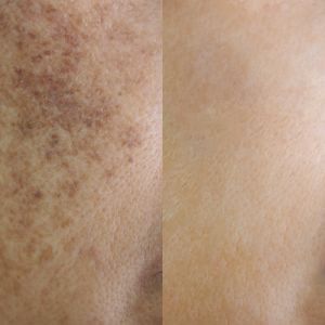 Pigmentation Removal