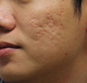 Acne Scar removal