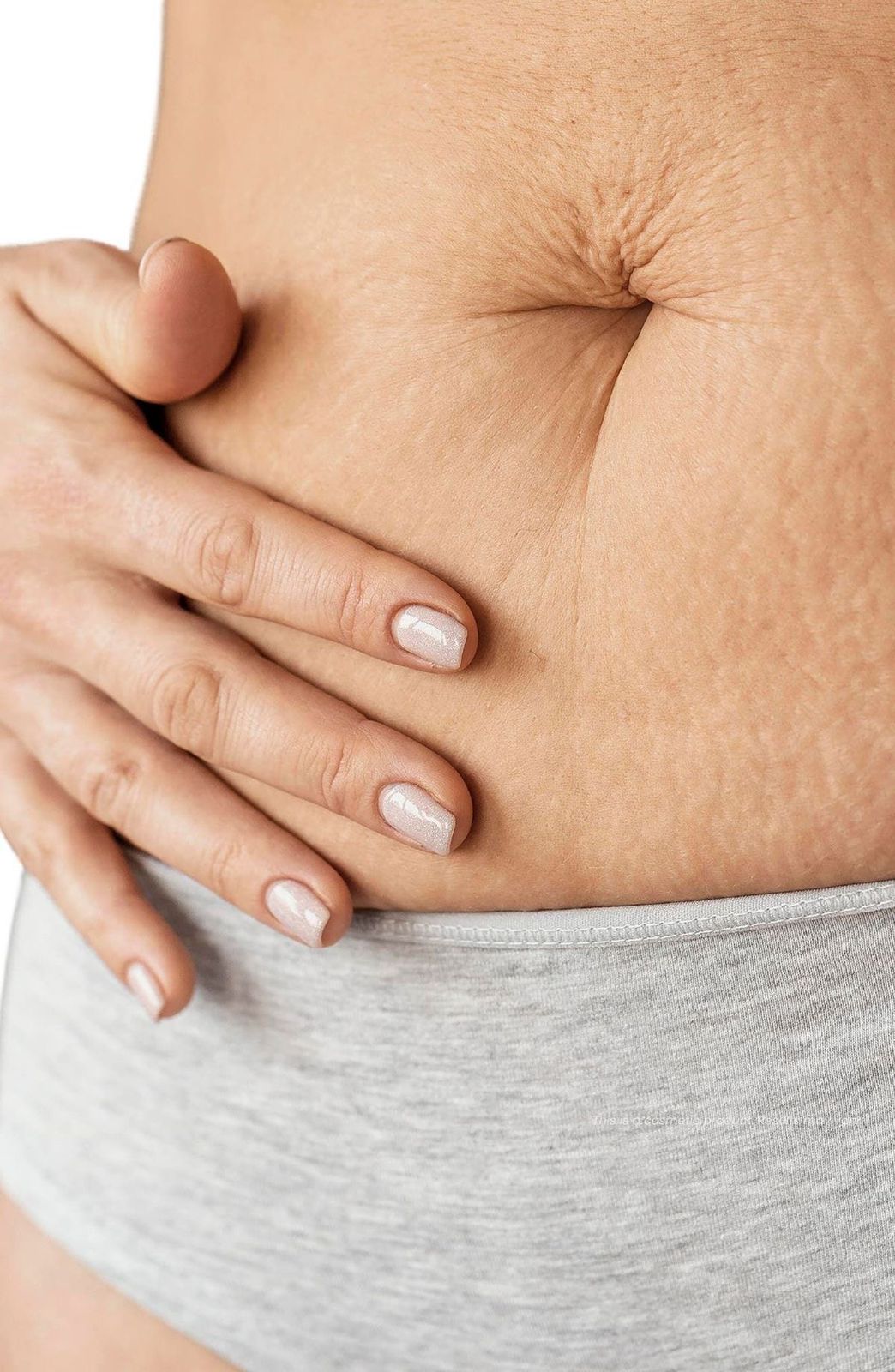 Stretch Marks Treatment